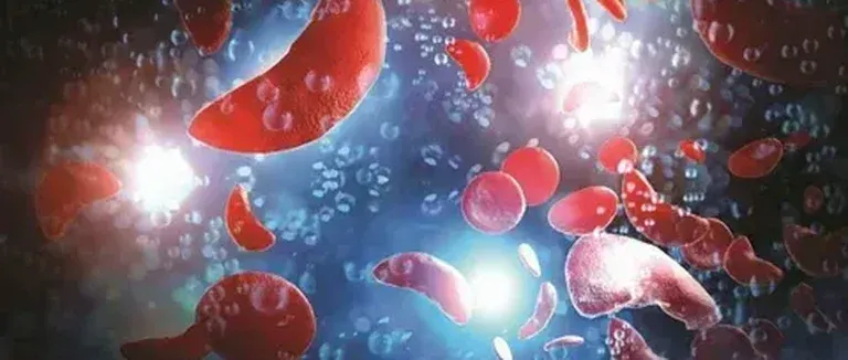Nouveautés dans le traitement de la drépanocytose : aperçu des avancées récentes
