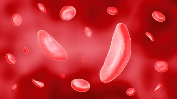 La Drépanocytose en Grèce et Macédoine : Histoire, Épidémiologie et Prise en Charge