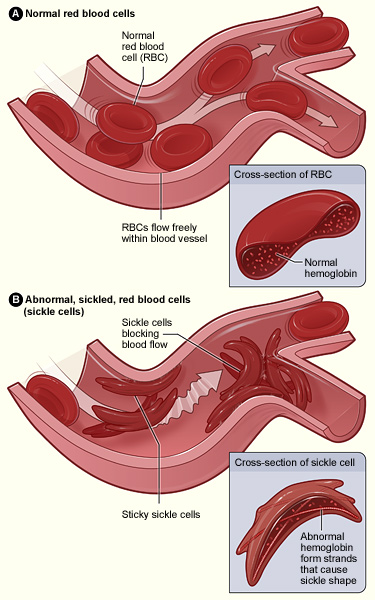 Les formes de la drépanocytose : HbSS, HbSC et β-thalassémie